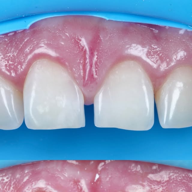 Caso de carillas de resina compuesta — detalle de dientes